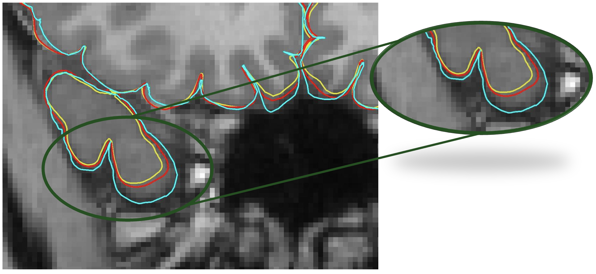 Whole-Brain Surface Overlay